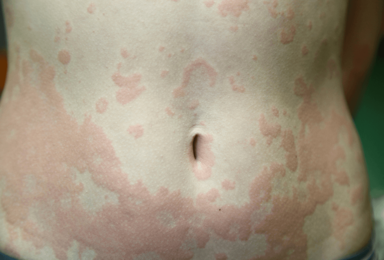 Dermatite atópica