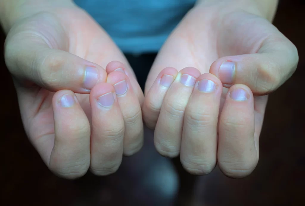 Unhas roídas: Entendendo e superando o hábito com 13 dicas 5 o que fazer para parar de roer unhas