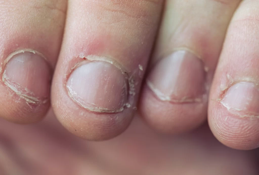 Unhas roídas: Entendendo e superando o hábito com 13 dicas 3 onicofagia