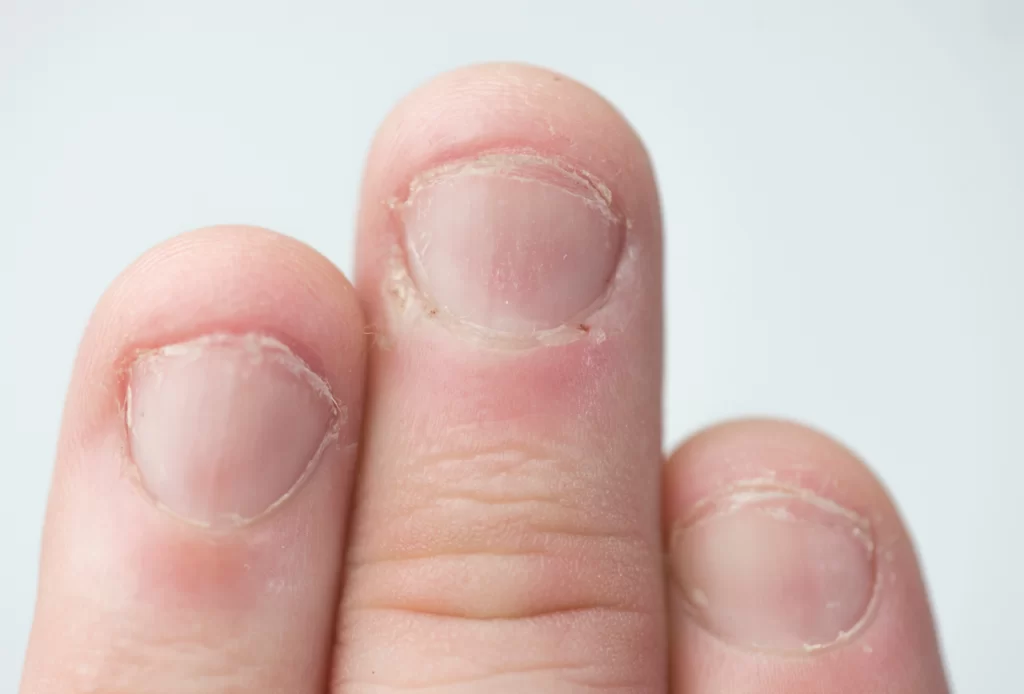 Unhas roídas: Entendendo e superando o hábito com 13 dicas 7 parar de roer unhas