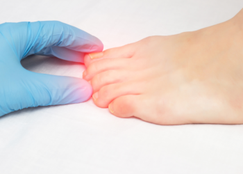 Micose de Unha como tratar