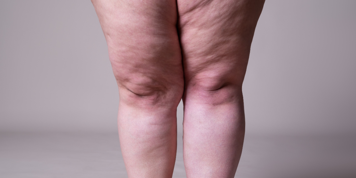 O Que é Lipedema: Como Identificar e Compreender Esta Condição Complexa 1 O Que é Lipedema?