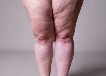 O Que é Lipedema?
