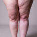 O Que é Lipedema: Como Identificar e Compreender Esta Condição Complexa 11 O Que é Lipedema?