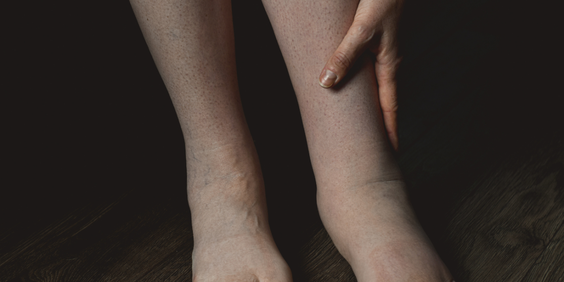 Retenção de líquidos: o que é, causas, sintomas, tratamentos e prevenção 1 causas da retencao de liquidos