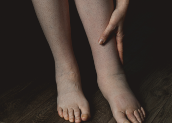 causas da retencao de liquidos